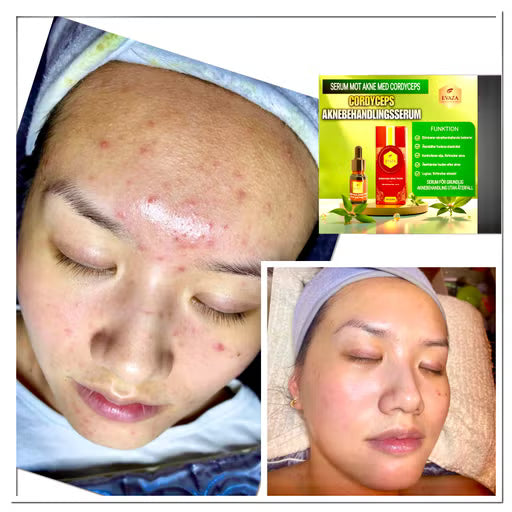Evaza cordycepd(Acne Serum)